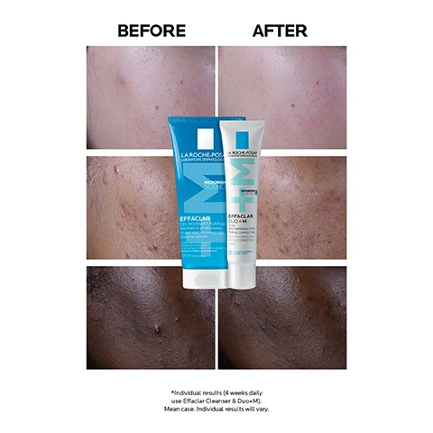 Image 1 - Before and after skin comparison showing improved complexion after using La Roche-Posay Effaclar products, with the text Before above the left side and After above the right side, featuring the product packaging in the middle and additional text stating *Individual results (4 weeks daily use Effaclar Cleanser & Duo+M). Mean case. Individual results will vary.
              Image 2 - A tube of La Roche-Posay Effaclar Duo+M is displayed against a light blue background, with bold text stating UP TO 3X LESS BREAKOUTS* UNCLOGS PORES TO HELP PREVENT SPOTS. 24H HYDRATION.
              Image 3 - A hand in a white glove holds a tube of La Roche-Posay Effaclar Duo + M skincare product against a light blue background, with text stating -45% POST-ACNE MARKS* and -66% BLACKHEADS*, along with additional product information and study details at the bottom.
              Image 4 - A hand holds a tube of La Roche-Posay Effaclar Duo+ cream while another hand catches a small amount of the cream, with text saying apply morning and/or evening after cleansing your skin with Effaclar foaming gel.
              Image 5 - A hand holds a tube of La Roche-Posay Effaclar Duo + M skincare product, featuring a light blue background with a five-star rating and testimonial text from a user about their positive experience with the product, along with the text No 1 dermatologist recommended skincare brand in the UK.
              Image 6 - Image of a La Roche-Posay skincare tube labeled Effaclar Duo+M with a blue and white design, featuring text that reads number one dermatologist recommended brand in the UK and number one cream for blemish-prone skin in the UK.
              Image 7 - Image shows three skincare products from La Roche-Posay labeled as Effaclar Purifying Foaming Gel, Effaclar Duo+M, and Anthelios Oil Control, with large numbers 1, 2, and 3 above them.
              Image 8 - Image shows the La Roche-Posay logo at the top, followed by a health professional icon and text stating Recommended by Dermatologists, then an icon of a person touching their face with text Suitable for Sensitive Skin, followed by a droplet with a slash and text For Oily, Combination, Blemish-Prone Skin, and a comedone icon with text Non-Comedogenic.
              Image 9 - A close-up of a person with short dark hair next to a white tube of La Roche-Posay Effaclar Duo+M cream, featuring text that reads La Roche-Posay, Effaclar Duo+M, Up to 3X less breakouts, 24HR hydration, unclogs pores to help prevent spots.
              Image 10 - A digitally created image showing a variety of blue and turquoise organic shapes and textures, overlaid with the text PHYLOBIOMA NEW ACTIVE INGREDIENT TARGETS EXCESS SEBUM.
              Image 11 - A close-up image of a persons face on the left and a blue-toned digital representation on the right, with visible text that reads Discover SpotScan+ for breakout-prone skin analysis developed by dermatologists & powered by AI.