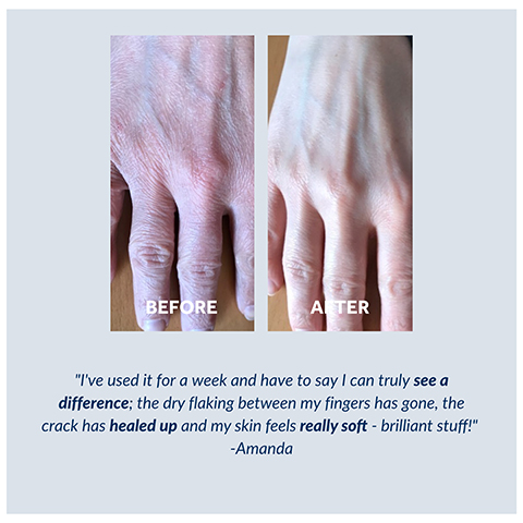 before and after model shot: Ive used it for a week and have to say that i can truly see a difference, the dry flaking between my fingers has gone, the crack has healed up and my skin feels really soft-brilliant stuff!- Amanda