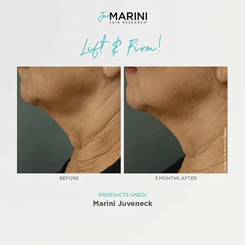 Image 1, Lift and firm before and after model shots after 3 months after, products used: marini juveneck. Image 2, 94% of study participants noted improved texture, wrinkles or laxity with Marini Juveneck