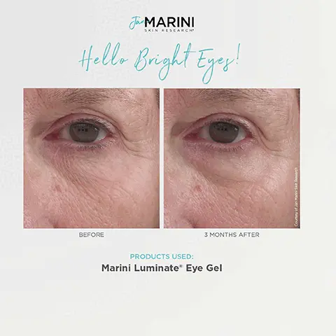 Image 1, Lift and firm before and after model shots after 3 months after, products used: marini lumiate eye gel. Image 2, refresh your eyes before and after model shots after 3 months after, products used: Marini lunimate eye gel