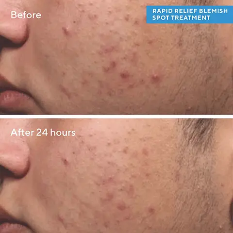 Before. After 24 hours. RAPID RELIEF BLEMISH SPOT TREATMENT. 92% Agree blemish appearance improved after 1 day + Reduces blemish size and redness within 4 hours. Proven results reported by 29 trial participants in a clinical study. Spot the difference. DEEP RELIEF BLEMISH TREATMENT Targets deep, under-the-surface, painful and swollen blemish bumps. RAPID RELIEF BLEMISH SPOT TREATMENT Targets surface breakouts, pimples and blemishes like blackheads and whiteheads.