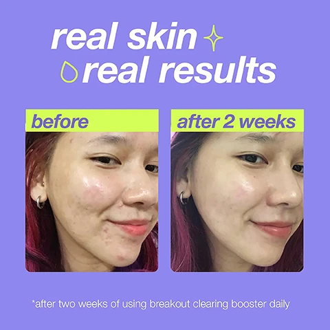 image 1, real skin, real results. before and after 2 weeks. after 2 weeks of using breakout clearing booster daily. image 2, niacinamide = helps skin barrier and even skin tone. TT technology and phytoplankton extract = prevent over drying. salicylic acid = combats breakout causing bacteria. image 3, ameri star 2023. 2023 sustainable packaging awar ameri star winner. new button = easy to dispense. image 4, real skin, real results. salicylic acid and TT technology clear breakout causing bacteria in 15 minutes.
