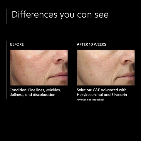 Image 1, differences you can see, before and after 10 weeks. condition = fine lines, wrinkles, dullness and discoloration. solution = C&E Advanced with hexylresorcinol and silymarin *photos not retouched. Image 2, verified customer review = it evens out my skin tone and makes my skin so soft with the first use.