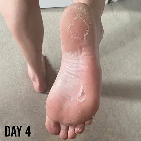 Image 1, DAY 4 Image 2 DAY 5 Image 3, FOR HAD Festing and AWARD WINNING BRITISH BRAND FOOT PEEL "wow I didn't think anything could save my feet lol! within days my hard skin started to peel and they are definitely noticeably softer. Might take a few more goes on my feet to get thme sorted but will definitely be buying this product again!" BARBER PRO FOOT PED FOR HARD, CALLUS SAI Peeling cl AWARD WINNING BRITISH BRAND AWARD WINNING Image 4, TOP TIP Soak your feet in water or take a warm shower first to soften the skin and make it more susceptible to the formula