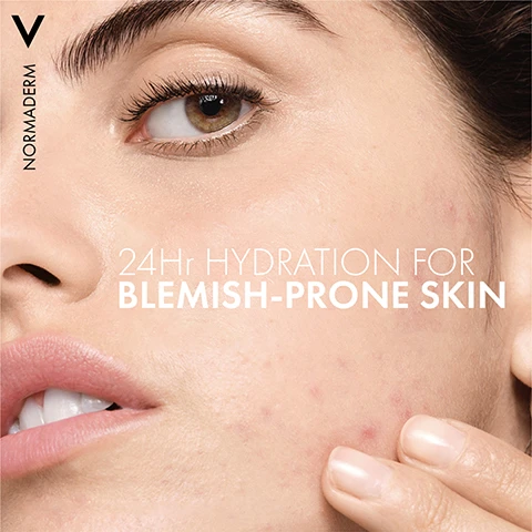 Image 1 - A close-up of a woman with blemish-prone skin showing her face, with visible text reading 24Hr HYDRATION FOR BLEMISH-PRONE SKIN and the brand name NORMADERM in the top left corner.
              Image 2 - A hand is shown with a clear gel-like substance being applied to it, accompanied by the text ULTRA LIGHTWEIGHT FAST ABSORPTION at the top left and NORMADERM in the top left corner.
              Image 3 - A green bottle of Vichy Normaderm skincare product is shown, with the text displaying NON-COMEDOGENIC NON-OILY NON-STICKY next to it.
              Image 4 - A person in a white coat holds a green bottle of Vichy Normaderm Double-Correction Moisturizing Care, with the text Recommended by Dermatologists prominently displayed.
              Image 5 - Image shows a skincare routine featuring three products from Vichys Normaderm line, including a cleansing gel on the left labeled STEP 1 CLEANSE, a correcting serum in the center labeled STEP 2 CORRECT, and a hydrating cream on the right labeled STEP 3 HYDRATE, all against a simple background with the title NORMADERM BLEMISH-PRONE SKIN ROUTINE.
              Image 6 - Image shows two green skincare bottles side by side with arrows indicating a change, labeled FROM above the left bottle and TO above the right bottle, and the text NEW PACKAGING IMPROVED FORMULA prominently displayed.