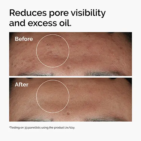 Image 1 - Image showing a comparison of skin before and after treatment, with visible changes in pore visibility and oiliness, accompanied by the text Reduces pore visibility and excess oil. Before on the top and After on the bottom, with a note about testing on 33 panellists using the product twice a day.
              Image 2 - Image shows a skincare regimen for oily, blemish-prone skin featuring four products: Glucoside Foaming Cleanser, Niacinamide 10% + Zinc 1%, Aloe 2% + NAG 2% Solution, and Natural Moisturizing Factors + Beta Glucan, with descriptions of each products benefits.