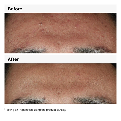 Image 1 - Image showing a close-up of a forehead divided into two sections labeled Before and After, with the Before section showing acne and uneven skin texture and the After section displaying smoother skin; testing on 33 panelists using the product 2x/day.
              Image 2 - A close-up of a persons face with a neutral expression, lightly touching their cheek, accompanied by text that reads, Boosts skin brightness and improves skin smoothness. 10% Niacinamide 1% Zinc PCA.
              Image 3 - A top-down view of a clear glass dish containing two droplets of a lightweight, water-based serum with bubbles, accompanied by text that reads Niacinamide 10% + Zinc 1% Lightweight water-based serum texture.
              Image 4 - Image shows a visual guide for skincare products divided into three sections labeled PREP for cleansers and toners, TREAT for water-based serums, eye serums, anhydrous solutions, and oils, and SEAL for suspensions, moisturizers, and SPF.