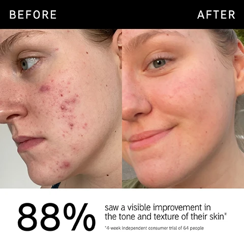 Image 1 - Image shows a side-by-side comparison of a womans face before and after skincare treatment, with visible improvement in skin tone and texture; visible text states 88% saw a visible improvement in the tone and texture of their skin and includes a note about a 4-week independent consumer trial of 64 people.
              Image 2 - A cosmetic serum bottle is shown with a black cap, featuring text that states Double dose of brightening and rejuvenation, Visibly reduces hyperpigmentation and evens skin tone, and Gentle, non-tacky, non-greasy formula.
              Image 3 - A close-up image of a woman with smooth skin smiling, with statistics next to her indicating that 88% saw a visible improvement in skin tone and texture, 87% agree skin looks brighter, and 84% agree skin looks healthier and less dull; the text includes VITAMIN C SERUM at the bottom.
              Image 4 - A close-up image of a gel-like substance with two sections of text that reads: Ingredients, 15% ASCORBYL GLUCOSIDE (VITAMIN C) Stabilized antioxidant Vitamin C helps brighten and improve the appearance of hyperpigmentation, 1% EPITENSIVE™ (EGF) Plant-derived peptide helps to visibly renew the skins appearance.
              Image 5 - A close-up of a smiling woman of color with natural makeup showcasing her skin, accompanied by text that answers FAQs about using a 15% Vitamin C serum, including recommendations for sensitive skin and layering with other ingredients.
              Image 6 - An image of a circular blob of yellow gel-like substance with bubbles, accompanied by text that reads How to layer your routine and numbered labels for steps: 1 Clean, 2 Hydrate, 3 Treat, 4 Moisturize, 5 SPF.
              Image 7 - A close-up portrait of a person with glowy skin and short hair, showing a thoughtful expression, with text that reads When to apply followed by icons for AM and PM.