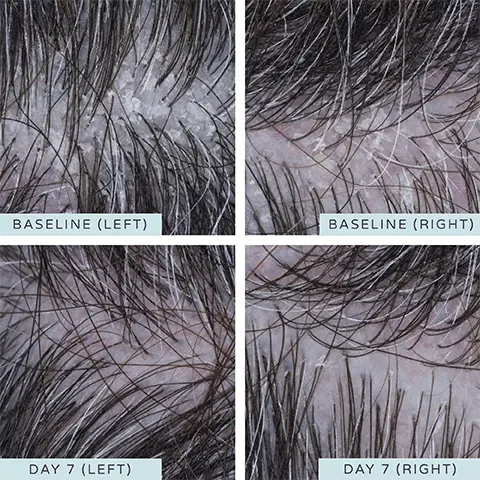 Images 1 to 6, Before and After model shots of the baseline before and after 7 days of the scalp