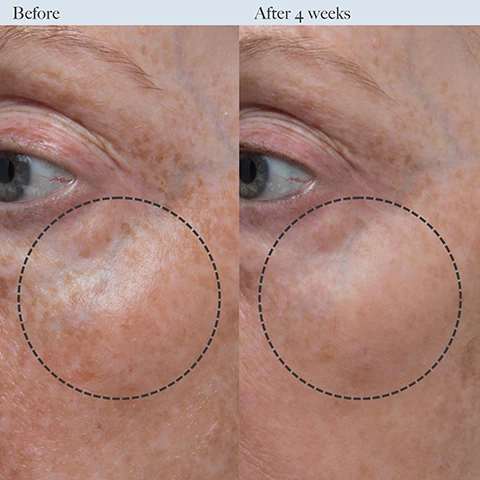 Image 1 - A side-by-side comparison of a persons skin around the eye area showing visible improvements after four weeks of treatment, with the left labeled Before and the right labeled After 4 weeks.
              Image 2 - Image comparison showing the left side labeled Before with a close-up of textured skin, and the right side labeled After 4 weeks displaying smoother skin in a similar area, with each side encircled by a dotted line.
              Image 3 - An image showing two cream-like textures with a transparent packet in the background, along with text that reads: Key Ingredients. 0.5% Retinol A type of retinoid (Vitamin A) that visibly improves loss of firmness and reduces the appearance of fine lines, wrinkles, and uneven skin tone. Bioidentical Skin Lipids Hydrate skin by mimicking naturally occurring ceramides (aka lipids) to fortify skins natural moisture barrier.