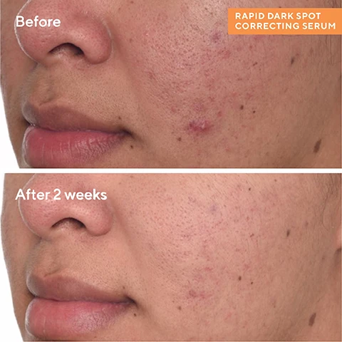 Image 1, before and after 2 weeks. image 2, 84% showed a reduction in the look of dark spots. 91% saw brighter skin. 945 noticed smoother skin. clinically proven results reported by 35 trial participants in a 2 week clinical study via instrumental measurements of areas with dark spots, with murad regimen. image 3, brighter day and night. AM - use vita-c glycolic serum in the morning for brightening and antioxidant defense. PM - use rapid dark spot correcting serum at night to target dark spots, smooth and boost radiance by morning. image 4, patented resorcinol technology = exclusive to murad, reduces the intensity of the look of dark spots and uneven tone. tranexamic acid = helps soothe, brighten and revive dull skin and even tone. glycolic acid = removes dulling surface cells to quickly enhance natural radiance, penetration and performance of ingredients. image 5, 3 steps to even tone. efficacious treatments to see fewer dark spots fast. 1 = essential c-cleanser - cleanse and pat dry. 2 = rapid dark spot correcting serum - apply serum over face, neck and chest. 3 = vita-c eyes dark circle corrector - gently pad corrector around the eye area.