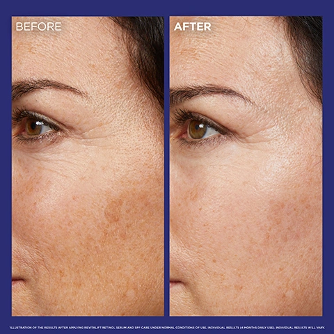 Image 1 - A split image of a womans face shows the area around her eye and cheek with the left side labeled BEFORE, displaying wrinkles and sun spots, and the right side labeled AFTER, showing visibly smoother skin with reduced wrinkles and faded discoloration, with a small disclaimer at the bottom that reads: ILLUSTRATION OF THE RESULTS AFTER APPLYING REVITALIFT RETINOL SERUM AND SPF CARE UNDER NORMAL CONDITIONS OF USE. INDIVIDUAL RESULTS (4 MONTHS DAILY USED) MAY VARY. Image 2 - A white text box on a dark blue background with blue spheres and bubbles contains the text: WHAT RESULT CAN I EXPECT ON MY SKIN? IMMEDIATELY, SKIN IS MOISTURISED, SUPPLE AND LOOKS SMOOTHER. SKIN TEXTURE IS REFINED, LOOKS YOUNGER AND IS MORE RADIANT. IN 4 MONTHS, DEEP WRINKLES APPEARED REDUCED FOR 9/10 WOMEN*. *47 OUT OF 52 AGREE, CONSUMER STUDY 8 WEEKS. Image 3 - A blue LOréal Revitalift Laser Pure Retinol Night Serum bottle with a dropper is displayed alongside usage instructions under a red banner titled RETINOL, which adds MAY CAUSE INITIAL REDNESS, DRYNESS OR TINGLING, followed by DIRECTION: APPLY 3-4 DROPS TO CLEAN, DRY SKIN IN THE EVENING BEFORE MOISTURISER, ALWAYS USE A MINIMUM OF SPF 20 THE MORNING AFTER, with a weekly schedule of WEEK 1 USE 2 NIGHTS PER WEEK, WEEK 2 USE EVERY OTHER NIGHT, WEEK 3 USE NIGHTLY AS TOLERATED, the bottle itself labeled LOREAL PARIS REVITALIFT LASER PURE RETINOL NIGHT SERUM, and a disclaimer at the bottom stating IT IS NORMAL TO EXPERIENCE SOME INITIAL REDNESS, TINGLING OR DRYNESS WHILE USING RETINOL, AVOID SUN EXPOSURE, AVOID CONTACT WITH EYES AND LIPS; IF CONTACT OCCURS RINSE THOROUGHLY WITH WATER, DO NOT USE IN CONJUNCTION WITH OTHER RETINOL PRODUCTS. Image 4 - A clear dropper releases a white droplet into an open dark blue LOréal Paris serum bottle, with text that reads Formula with Pure Retinol, a top dermatologist recommended ingredient to correct wrinkles. Image 5 - A hand holds a blue LOreal Revitalift Laser Pure Retinol Night Serum bottle, with a dropper positioned above it, next to text that reads VALIDATED WITH DERMATOLOGISTS, THOROUGH REVIEW OF TEST PROTOCOLS AND RESULTS, COMPREHENSIVE INGREDIENT SCREENING FOR EFFICACY, SAFETY AND TOLERANCE. Image 6 - A white card on a blue background shows a three-week product usage guide with the text Week 1 Use 2 Nights Per Week, Week 2 Use Every Other Night, Week 3 Use Nightly As Tolerated.