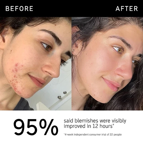 Image 1 - Before and after comparison of a persons face showing significant improvement in skin texture; visible text reads 95% said blemishes were visibly improved in 12 hours and *4-week independent consumer trial of 22 people.
              Image 2 - A tube of succinic acid treatment is shown with a green cream swatch beside it, accompanied by visible text stating clinically proven to visibly improve blemishes, clinically proven to visibly reduce redness, and targeted treatment plus non-drying, gentle formula.
              Image 3 - A close-up of a woman with a glowing complexion applying a clear gel to her cheek, accompanied by text that states 95% said blemishes were visibly improved in 12 hours, 91% said redness appeared reduced in 4 hours, and 100% said it felt gentle on the skin, with a note about a 4-week independent consumer trial of 22 people.
              Image 4 - Image showing a green background with text listing ingredients: 2% Succinic Acid - Helps to reduce appearance of blemishes and excess oil, 2% Sulfur Powder - Absorbs excess oil, 1% Salicylic Acid - Helps unclog pores and gently exfoliate.
              Image 5 - A close-up of a woman smiling and applying skincare product on her face, with text overlaying the image that reads: FAQ SHOULD I USE THIS BEFORE OR AFTER OTHER SKINCARE? Apply directly to areas of concern up to 3x a day. Allow 5 minutes to dry before following with the rest of your skincare/makeup. WHAT CAN I LAYER IT WITH? We recommend not applying actives such as AHAs, BHAs, Retinol, Vitamin C or Niacinamide on the same area you wish to use Succinic Acid on.
              Image 6 - An illustration of a light green cream swatch is shown above the text that reads How to layer your routine, with numbered steps below: 1. Clean, 2. Hydrate, 3. Treat, 4. Moisturize, 5. SPF.
              Image 7 - A close-up of a person pointing to their cheek with a small green product dot on their skin, accompanied by the text: When to apply; AM; PM.
              Image 8 - A hand holds a finger out with a small amount of light green cream being dispensed from a tube labeled SUCCINIC ACID TREATMENT and the text on the left reads Amount to apply with Raspberry-sized amount below it alongside a droplet icon.
              Image 9 - Image shows a comparison of two skincare products: a tube labeled Succinic Acid Treatment on the left and a box of Hydrocolloid Invisible Pimple Patches on the right, with text sections beneath each product detailing their best uses, hero ingredients, and targets for effectiveness.