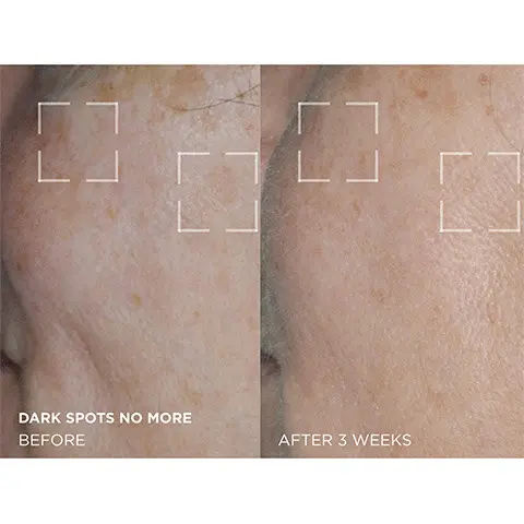 Before application of the dark spots no more and how the skin looks after 3 weeks
