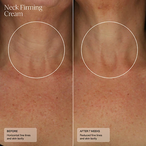 neck firming cream before horizontal fine lines and skin laxity and after 7 weeks, reduced fine lines and skin laxity.