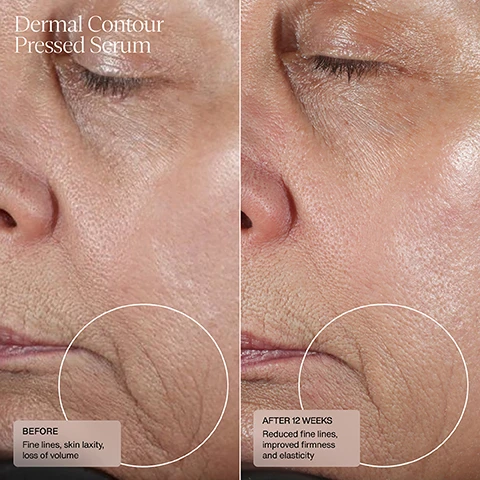 image 1, dermal contour pressed serum, before - fine lines, skin laxity, loss of volume. after 12 weeks - reduced fine lines, improved firmness and elasticity. Image 2, dermal contour pressed serum, before - skin laxity and loss of volume. after 12 weeks - improved firmness and elasticity.