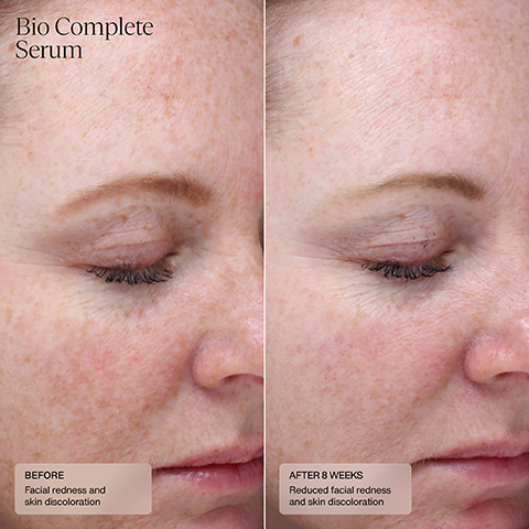 Image 1, bio complete serum, before - facial redness and skin discoloration. after 8 weeks - reduced facial redness and skin discoloration.