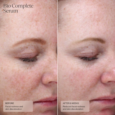 Image 1, bio complete serum, before - facial redness and skin discoloration. after 8 weeks - reduced facial redness and skin discoloration. Image 2, bio complete serum and dermal repair cream, before - fine lines, after 4 weeks - reduced fine lines.