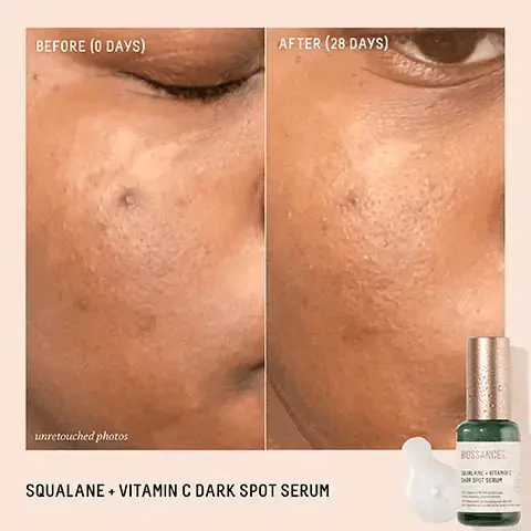 Image 1, BEFORE (0 DAYS) AFTER (28 DAYS) unretouched photos SQUALANE + VITAMIN C DARK SPOT SERUM BOSSANCE ALANE VITAMIN DARK SPOTSERUM Image 2, BIOSSANCE: VITAMIN C SQUALANE DARK SPOT SERUM WC White Sh Went visiblement i Wet chameleon Diction AFTER 1 WEEK 100% agree the look of dark spots is improved1 100% agree the look of sun damage is improved1 97% saw a visible improvement in fine lines and wrinkles' Based on a 21 day consumer study of 38 female subjects. oges 20-58, after twice daily use Image 3, BOSSANCE: SALANE. VITAMIN C CAK SPOT SERUM → VITAMIN C 10% A potent antioxidant that visibly brightens and firms without causing irritation WHITE SHIITAKE MUSHROOM EXTRACT Synergistic mushroom blend that visibly corrects dark spots and targets the formation of new ones LICORICE ROOT EXTRACT Calms and mitigates the look of discoloration and fights the appearance of future dark spots Image 4, RADIANT COMPLEXION DYNAMIC DUO AM SQUALANE + VITAMIN C DARK SPOT SERUM Correct and prevent dark spots Even skin tone BIOSSANCE: SQUALANE. VITAMINC CARK SPOT SERUM BOSSANCE ALANE LACTIC ACID ESURFACING NIGHTSER MO CPM SQUALANE LACTIC ACID RESURFACING NIGHT SERUM Reduce look of large pores Smooth rough texture