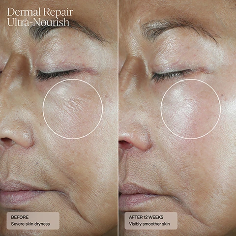 Image 1, dermal repair ultra nourish. before severe skin dryness. after 12 weeks visibly smoother skin. image 2, dermal repair ultra nourish. before - skin dryness and facial redness. after 12 weeks - reduced dryness and facial redness.