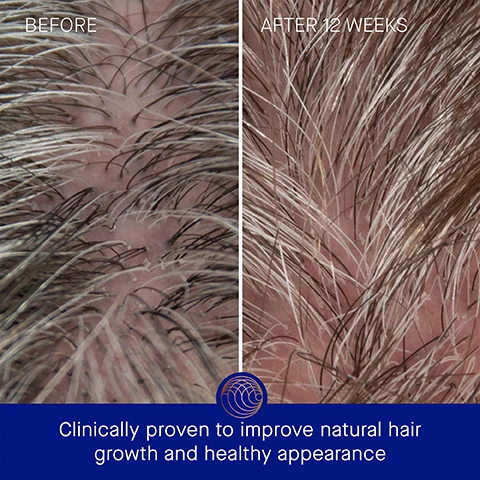 Image 3 - Image shows a comparison of hair growth on a scalp, with the left side labeled Before showing sparse hair and the right side labeled After 12 Weeks showing fuller hair, with visible text below stating Clinically proven to improve natural hair growth and healthy appearance.
              Image 4 - Image shows a comparison of hair before and after 12 weeks of treatment, with the left featuring frizzy, dull hair and the right displaying smoother, shinier hair; visible text includes BEFORE, AFTER 12 WEEKS, and Clinically proven to enhance hair shine and strength.
              Image 5 - A blue tube of Augustinus Bader conditioner is displayed on a light background with visible text stating Clinically Proven Results, followed by claims that hair strength is increased by 2.1x, hydration by 97%, and appears healthier by 2.3x, along with a note about a clinical trial.
              Image 6 - Image shows a blue tube of conditioner held in a hand against a light green textured background, with visible text stating User Proven Results, 97% agree The Conditioner visibly improves natural hair growth, 100% agree hair breakage is visibly decreased, 100% agree hair felt more hydrated, and *In a 12-week Consumer Perception Study of 105 m/f with all hair types.
              Image 7 - A blue tube of Augustinus Bader conditioner is centered against a gradient background, with text highlighting key ingredients and benefits: TFC8® - A proprietary technology that creates the optimal environment for skin cellular renewal, Castor Seed Oil - Reduces breakage and improves elasticity, Oat Kernel Oil - Supports elasticity, nourishes, and hydrates hair, and Pomegranate Extract - Protects against visible signs of damage.
              Image 8 - Image shows two product tubes side by side: on the left, The Conditioner, described as a lightweight cream conditioner with text indicating key benefits, concerns, and ideal hair types; on the right, The Rich Conditioner, described as a rich silky conditioner with similar informational text, all set against a contrasting background.
              Image 9 - Image shows a product application guide with three steps: Step 1: Apply to clean, damp hair; Step 2: Work through the length of the hair using The Neem Comb or your fingers, starting from the midshaft of the scalp (as needed); Step 3: Rinse thoroughly after 1-2 minutes. The background features a decorative design.