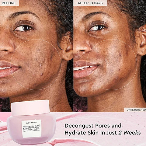 Image 1 and 2, before and after 10 days. decongest pores and hydrate skin in just 2 weeks. unretouched.