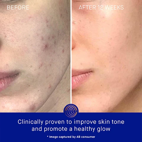 Image 3 - A split image showing the left side labeled BEFORE with visible acne on the cheek, and the right side labeled AFTER 12 WEEKS showing clearer skin, with the text Clinically proven to improve skin tone and promote a healthy glow at the bottom.
              Image 4 - A blue cosmetic bottle with a gold cap is displayed on a marble surface, accompanied by text stating Clinically Proven Results, Skin looks 52% younger, Skin hydration is improved by 3.3x after 1 hour, and The appearance of fine lines and wrinkles are reduced by 32%.
              Image 5 - A bottle of Augustinus Bader skincare cream is displayed alongside user statistics showing 83% agree skin feels instantly and deeply hydrated, 92% agree dull skin appears more luminous, and 79% agree skin discoloration is diminished and skin looks more even, with fine print indicating the results are based on a 4-week Consumer Perception Study of 52 participants.
              Image 6 - A blue and gold skincare bottle of Augustinus Baders The Cream with TFC8® is shown against a blurred blue background, with text highlighting benefits of the ingredients: TFC8® A proprietary technology that creates the optimal environment for skin cellular renewal, Vitamin A Visibly reduces fine lines, wrinkles and pigmentation, Vitamin B5 Locks in moisture and plumps, and Vitamin C Supports collagen production and brightens complexion.
              Image 7 - The image shows two skincare products side by side: on the left is The Cream, a lightweight daily moisturizer with key benefits of hydrating and revitalizing, and ideal for combination to oily skin; on the right is The Rich Cream, a luxuriously rich daily moisturizer with key benefits of nourishing and renewing, ideal for normal to dry skin.
              Image 8 - A skincare routine layout featuring four steps with product images: 1. Cleanse - THE CREAM CLEANSING GEL, 2. Correct & Hydrate - THE SERUM, 3. Nourish & Renew - THE CREAM, THE RICH CREAM OR THE ULTIMATE SOOTHING CREAM, 4. Perfect & Revitalize - THE EYE CREAM.
              Image 9 - Four skincare products in blue packaging with gold accents arranged from left to right, labeled 15 ml, 30 ml, 50 ml, and 100 ml, displaying the text AB Augustinus Bader and THE CREAM WITH TFC8.