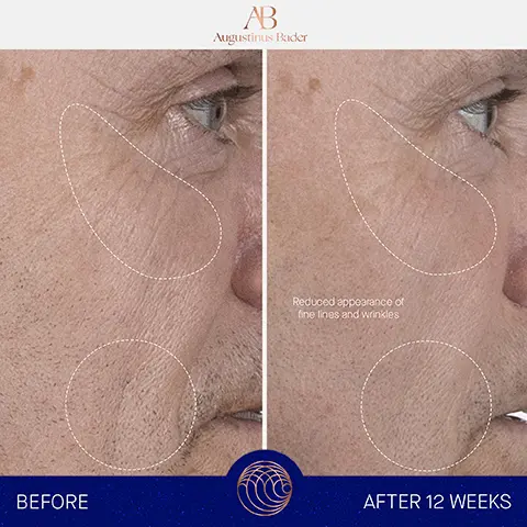 Image 1, AB Augustinus Bader Reduced appearance of fine lines and wrinkles BEFORE AFTER 12 WEEKS Image 2, Step 1 Dispense 2-3 pumps into hands Step 2 In upward, sweeping motions, smooth over the face, neck and decollete until fully absorbed Step 3 Follow by applying your Augustinus Bader moisturizer and/or oil