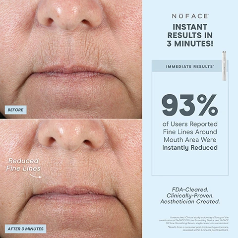 Image 1, instant results in 3 minutes. before and after 3 minutes - reduced fine lines. immediate results 93% of users reported fine lines around mouth area were instantly reduced. FDA cleared, clinically proven and aesthetician created. unretouched clinical stuy evaluating efficacy of the combination of nuface fix line smoothing device and nuface fix line smoothing serum single center non randomised. results from a consumer post treatment questionnaire assessed within 2 minutes post treatment. image 2, 1 device to blur, depuff and plump. 3 minutes per area, energizing hum, 60 treatments per charge. targeted spheres for eyes and lips. 1 intensity. cap included for on the go fixing. your quick fix perfect for instant finisher. FDA cleared, clinically proven, aesthetician created. image 3, instant results in 3 minutes. depuff under eye, enhance lip volume. blur fine lines. image 4, instant results in 3 minutes. before and after 3 minutes - tighter under eye. immediate results = 97% saw instantly tighter skin around the eyes. FDA cleared, clinically proven, aesthetician created. unretouched, clinical study evaluating efficacy of the combination of nuFACE fix line smoothing device and nuFACE fix line smoothing serum single center non randomised. results from a consumer post treatment questionnaire assessed within 2 minutes post treatment. image 5, instant results in 3 minutes. blur fine lines, depuff under eyes, enhance lip volume. image 6, instant results. results in just 3 minutes. blur fine lines and wrinkles. enhance lip line. depuff underyes. image 7, trinity = customised lifting. depth - to the muscle. intensity levels - 5. attachment options - eye an lip attachment and LED red light attachment sold separately - yes. micro current treatment areas - jowls and jawlines, neck, cheeks and forehead, around eyes and brows, around mouth and lips, smile lines. mini on the go-lifting = depth of treatment - to the muscle. intensity levels - 3. microcurrent treatment areas - jowls and jawline, neck and cheeks and forehead. fix instant finisher = depth of treatment - skin's surface. intensity levels - 1. microcurrent treatment areas - around eyes and brows, around mouth and lips, smile lines