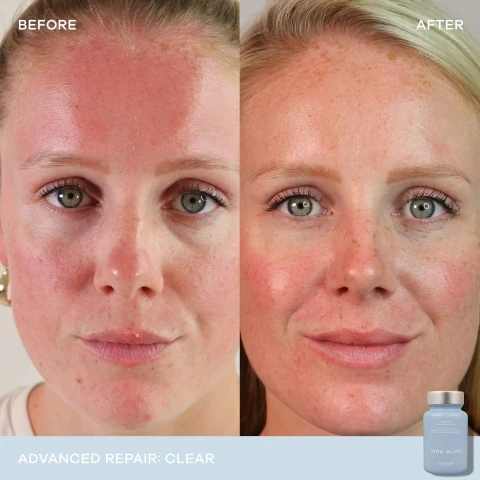 image 1, before and after advanced repair: clear. image 2, pure beauty global awards winner 2023