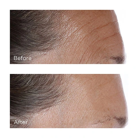 Before and After images. The after image shows a smoother forehead with reduced wrinkles