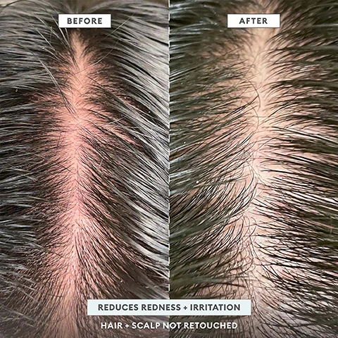 Image 1 - Image shows a comparison of a scalp before and after treatment, with the left side labeled Before showing redness and irritation, and the right side labeled After showing reduced redness, accompanied by text that reads REDUCES REDNESS + IRRITATION HAIR + SCALP NOT RETOUCHED.
              Image 2 - Side-by-side comparison of a scalp before and after treatment showing improved hair condition with visible text stating BEFORE on the left and AFTER on the right, along with BUSTS FLAKES + REDUCES DANDRUFF and HAIR + SCALP NOT RETOUCHED at the bottom.
              Image 3 - Close-up images comparing a scalp before and after treatment, showing flakes and hair strands; visible text reads BEFORE, AFTER, and BUSTS FLAKES HAIR + SCALP NOT RETOUCHED.
              Image 4 - Image shows a skincare product with descriptions of its ingredients: powerful AHA/BHA blend, Binchotan charcoal, coconut oil, and tea tree + peppermint oil, along with corresponding imagery of each ingredient.
              Image 5 - Image shows three hair care products from Briogeo labeled Scalp Revival alongside fresh mint leaves and charcoal, with text describing their benefits: treat your scalp like you treat your skin, Chemical Exfoliator powerful AHA/BHA blend exfoliates without stripping hair of vital moisture and nutrients, Cooling Hydration soothes scalp + restores moisture after exfoliation, and Physical Exfoliator detoxifies + removes scalp buildup.
              Image 6 - A display of various hair care products from Briogeo, including bottles and jars, arranged artistically with a coconut and mint leaves, against a pale blue backdrop, featuring the text scalp care = healthy hair™.
              Image 7 - A bottle of Briogeo Scalp Revival shampoo is displayed on a reflective surface with mint leaves and charcoal pieces beside it, and the text reads: CLEAN FORMULA, POWERFUL RESULTS gentle enough for daily use.
              Image 8 - A circular graphic promoting 6-free hair care with text indicating it contains no silicones, no harsh sulfates, no parabens, no phthalates, no DEA, and no artificial dyes, along with icons for vegan, cruelty-free, and gluten-free.