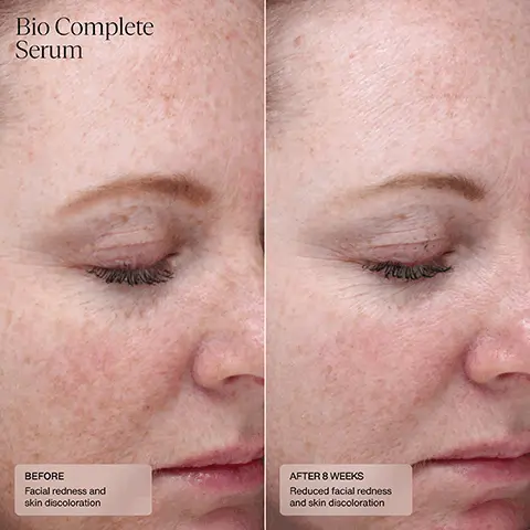 HydraFirm, Before, Skin laxity and loss of volume. After 12 weeks, Improved firmness and elasticity. HydraFirm, Before, Fine lines, skin laxity, loss of volume. After 12 weeks, Reduced fine lines, improved firmness and elasticity. Bio Complete Serum. Before, Facial redness and skin discoloration. After 8 weeks, reduced facial redness and skin discoloration.