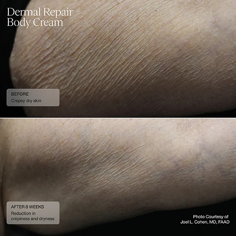 Image 1, dermal repair body cream, before - crepey dry skin. after 8 weeks - reduction in crepiness and dryness. Image 2, dermal repair body cream. before - loose, rough dry skin. after 12 weeks - improvement in skin laxity, texture and dryness.