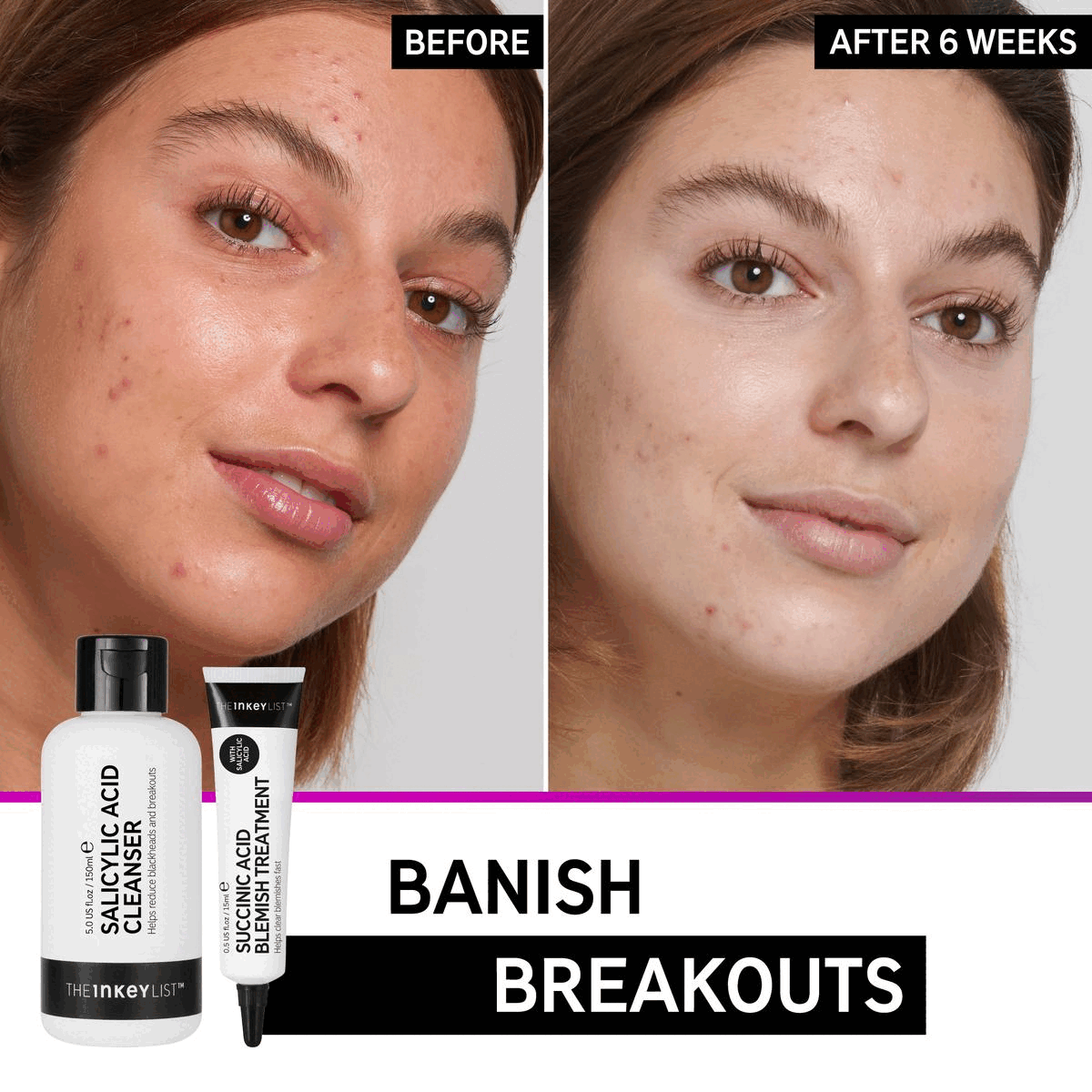Image 1, Before and After 6 weeks, Banish breakouts Image 2, Salicylic Acid Cleanser, Succinic Acid Treatment, Omega Water Cream Image 3, STEP 1 Remove makeup and dirt, while helping to reduce blackheads and breakouts STEP 2 Clear blemishes fast, reduce inflammation and prevent clogged pores STEP 3 Immediately hydrate skin without oiliness