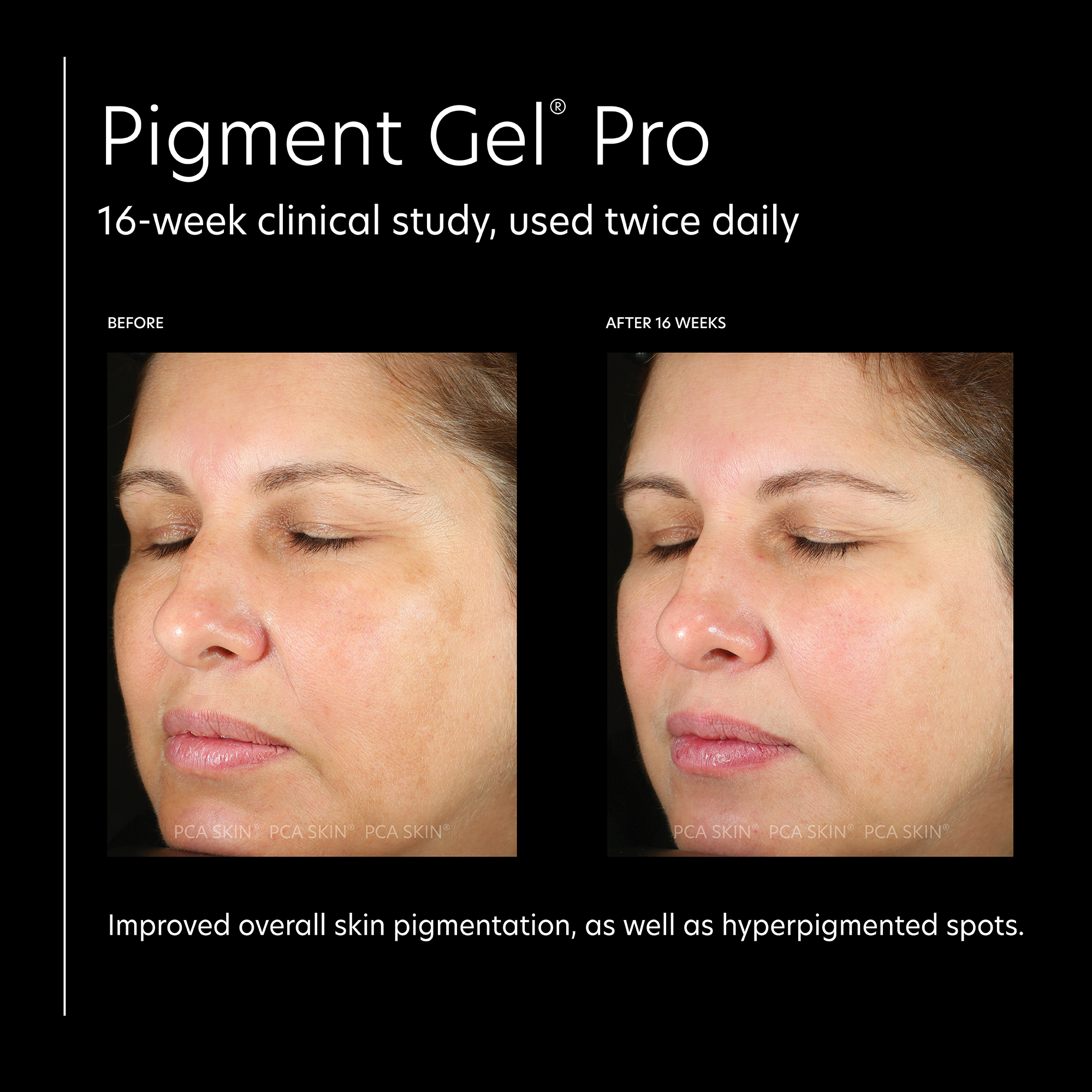 Image 1, Before and after, 16 week clinical study. Improved overall skin pigmentation, as well as hyperpigmentation spots. Image 2, helps improve visible discoloration while helping to protect against the appearance of new dark spots. Image 3, our most advanced dark spot serum corrective serum, dermatologically tested hydroquinone-free serum that targets dark spots and discoloration. Image 4, the new gold standard in pigment correction. Image 5, visibly improve stubborn dark spots and other forms of discoloration, before and after