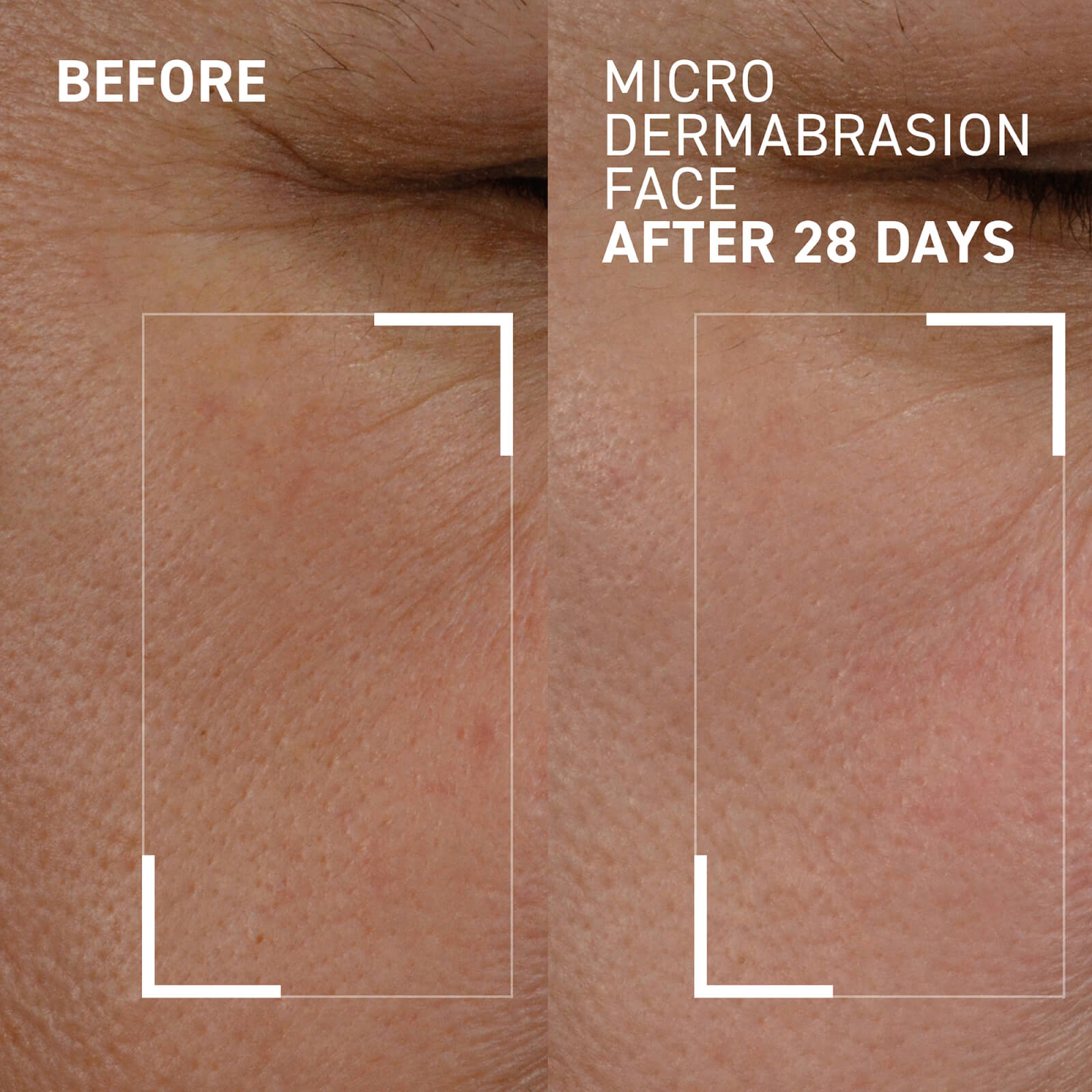 before microc dermbrasion face after 28 days