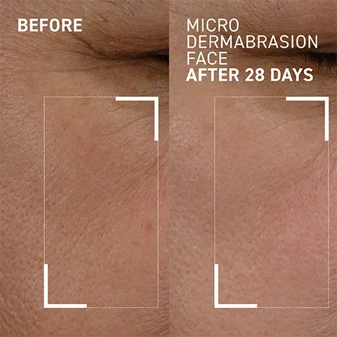 Before application then how the eye area looks after 28 days of using the Micro Dermabrasion Face exfoliator