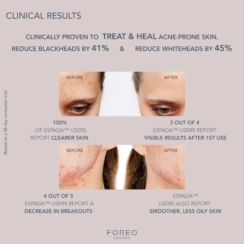 clinical results. clinically proven to treat and heal acne prone skin, reduce blackheads by 41% and reduce whiteheads by 45%. before and after. 100% of espada users report clearer skin. 3 out of 4 espada users report visible results after 1st june. 4 out of 5 espada users report a decrease in breakouts. espada users also report smoother, less oily skin. based on a 28 day consumer trial