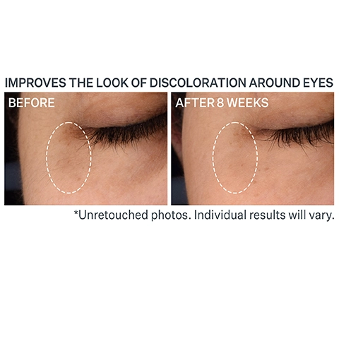 Before and after model shot after 8 weeks. Improves the look og discolouration around eyes
