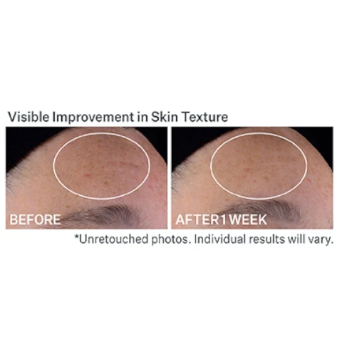 visible improvement in skin texture, un retouched photos, individual results will vary. before and after 1 week