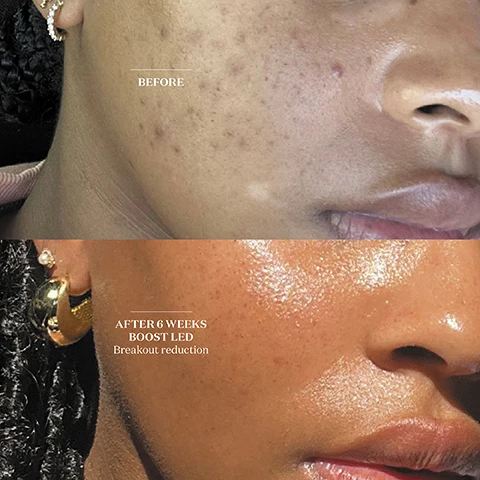image 1, before and after 6 weeks boost LED - breakout reduction. image 2, before and after 6 weeks boost LED and peptide serum wrinkle reduction. image 3, before and after 3 times boost LED cleanse and recovery. reduced redness. image 4, before and after 6 weeks boost LED and cleanse and recovery - rosacea reduction. image 5, before and after 6 weeks boost LED and enzymatic cleanser, cleanse and recovery, peptide serum and LED - reduced inflammation, reduced blemishes.