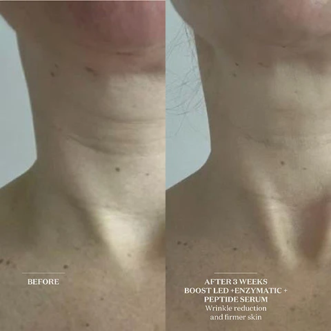 image 1, before and after 3 weeks boost LED, enzymatic and peptide serum. wrinkles reduction and firmer skin. image 2, boost LEF decolletage bib - transformative skincare technology. what does it do? targeting the neck and best at a cellular level, boost LED stimulates the skin's production of collagen, elastin and hyaluronic acid, leading to plumper, firmer more hydrated skin. it also reduces breakouts, redness and the appearance of age spots. image 3, how often should i treat my skin? consistency is key, so we recommend incorporating boost into your daily or nightly skincare routine. our clinical trials show visible results from boost LED after four weeks when used 3-5 times a week. can i use the bib on my back? the bib is especially effective at targeting blemishes and sun damage on the neck and shoulders. simply secure using the adjustable strap and switch on. image 4, boost LED decolletage bib founder notes, hannah measures said = the often neglected decolletage is particularly prone to shoeing the signs og ageing and sundamage. so following the success of our original face mask, we developed the bib to target and transform the skin on the neck and chest.