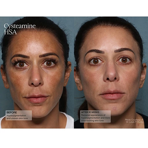 Image 1, cysteamine HSA, before = hyperpigmentation and uneven skin tone. after 8 weeks - reduced appearance of hyperpigmentation and more even looking skin. Image 2, cysteamine HSA, before - stubborn dark spot and uneven skin tone. after 16 weeks, reduced appearance of dark spot and more even looking skin tone. Image 3 and 4, cysteamine HSA, before - hyperpigmentation. after 16 weeks - reduced appearance of hyperpigmentation. Image 5 and 6, cysteamine HSA and even tone retinol cream, before - hyperpigmentation and uneven skin tone. after 7 weeks - reduced appearance of hyperpigmentation and more even looking skin tone.