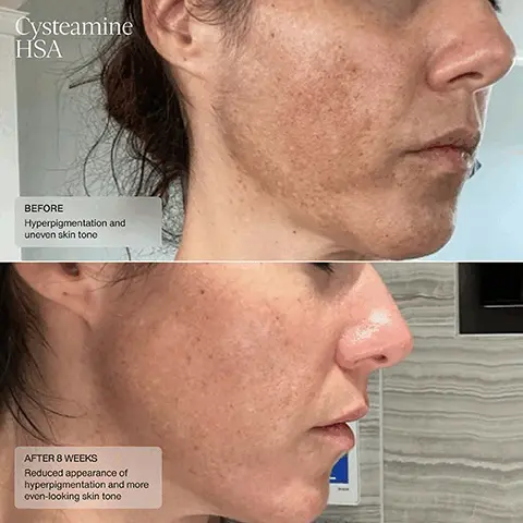 Image 1, Cysteamine HSA BEFORE, Hyperpigmentation and uneven skin tone AFTER 8 WEEKS, Reduced appearance of hyperpigmentation and more even-looking skin tone. Image 2, Cysteamine HSA BEFORE, Stubborn dark spot and uneven skin tone, AFTER 16 WEEKS Reduced appearance of dark spot and more even-looking skin tone. Image 3, Cysteamine HSA BEFORE, Hyperpigmentation, AFTER 16 WEEKS Reduced appearance of Hyperpigmentation. Image 4, Cysteamine HSA BEFORE, Hyperpigmentation, AFTER 6 WEEKS Reduced appearance of Hyperpigmentation. Image 5, Cysteamine HSA and Even Tone Retinol Cream BEFORE, Hyperpigmentation and uneven skin tone, AFTER 7 WEEKS, Reduced appearance of hyperpigmentation and more even-looking skin tone, Photo Courtesy of DERMA MD CO., LTD. Image 6, Cysteamine HSA and Even Tone Retinol Cream BEFORE, Hyperpigmentation and uneven skin tone, AFTER 7 WEEKS, Reduced discoloration and more even-looking skin tone Photo Courtesy of DERMA MD CO., LTD