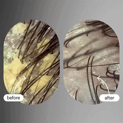 Image 1 & 2- Before and After shots to show reduction in flakiness. Image 5, 1-2 uses, soothes itchy and flaky scalp, 3-4 uses, scalp oils are balanced, 5-6 uses, reduces appearance of dandruff Image 3, 93% agree flakes are reduced, 92% agreed scalp felt soothed, proven results, results from a consumer perception study with all hair and scalp types Image 4, Scalp Renew Ingredients: Salicylic Acid (0.15%) Removes flakes by gently exfoliating the scalp and removes excess oil, Papaya Extract (0.10%) Fruit enzymes that gentle remove dead skin and flakes while nourishing the scalp, Peppermint + Menthonal Blend Cools and refreshes the scalp while soothing the scalp, Production: Ethical Labor, Manufacturing Method 100% Cold Processed, Packaging: Tube Aluminum, Nozzle Aluminum, Recyclability 85% Box Material Certified Post Recycled, Image 5, Loved by Goop, Forves, Coveteur, Elite Daily, Byrdie Image 6, shop scalp best seller, pre-cleanse oil to breakdown buildup, gentle scalp exfoliator with salycilic acid, hydrating growth serum  Image 8, Best Seller, Shop Scalp, pre-cleanse oil to break down buildup, gentle scalp exfoliator with salycilic acid, hydrating growth serum