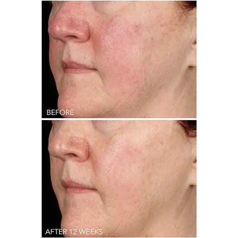 Image 1 to 3, Before and After results shots