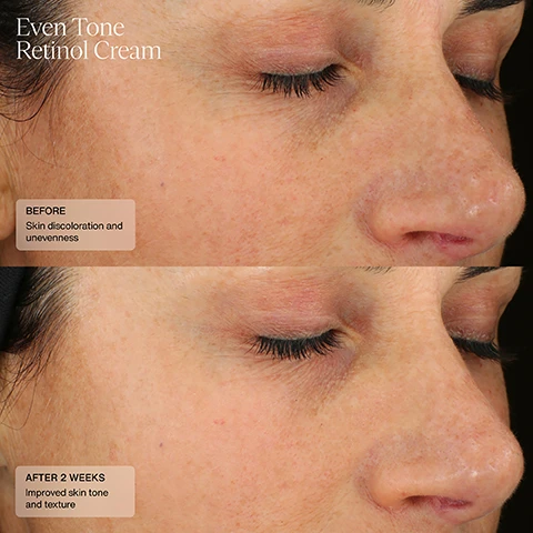 Image 1, even tone retinol cream, before - skin discoloration and unevenness. after 12 weeks - improved skin tone and texture. Image 2, even tone retinol cream, before - skin discoloration and unevenness. after 8 weeks - improved appearance of skin tone and texture. Image 3 and 4, cysteamine HSA and even tone retinol cream, before - hyperpigmentation and uneven skin tone. after 7 weeks - reduced appearance of hyperpigmentation and more even looking skin tone.