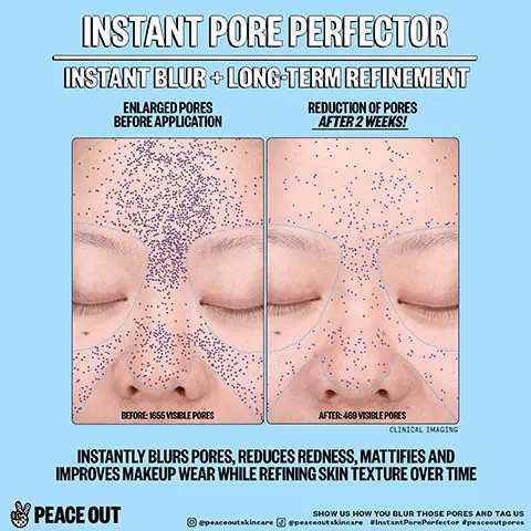 Image 1, instant pore perfector instant blur plus long refinement. enlarged pores before application and reduction of pores after 2 weeks. instantly blurs pores, reduces redness, mattifies and improves makeup wear while refining skin texture over time. Image 2, peace out instant pore perfector. immediatly blur pores, reduce redness, improve makeup wear, refine skin texture over time. the ingredients, hyaluronic acid blend = blurs visible pores and primes skin for makeup. niacinamide = tackles uneven skin tone and promotes clearer looking skin. mushroom extract = minimizes pores and helps to calm redness. malic acid = promotes a smooth, even looking complexion. Image 3, peace instant pore perfector. how it works and how to use it = apply in the AM as a final step of skincare before makeup. gently press product into moisturized skin focusing on large pores. no makeup? use alone to address enlarged pores, texture and redness. instantly blurs pores and refines skin texture over time.