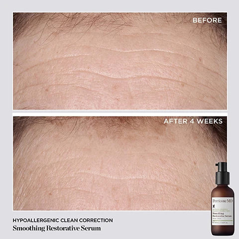 Image 1 - The image shows a comparison of a forehead before and after using a smoothing restorative serum, with noticeable reduction of fine lines and wrinkles after four weeks; visible text includes BEFORE, AFTER 4 WEEKS, HYPOALLERGENIC CLEAN CORRECTION, and Smoothing Restorative Serum.
              Image 2 - A brown bottle labeled Perricone MD Smoothing Restorative Serum sits on a light background with cream flowing beside it, showing the following statistics: 92% felt smoother, supple skin, 90% showed significant improvement in skin firmness, texture, radiance, & brightness, and 84% showed a significant reduction in fine lines, with smaller text below noting the source of the claims.
              Image 3 - A brown glass serum bottle labeled Perricone MD sits on a textured rock with fresh green basil leaves beside it, featuring text labels for Holy Basil, Niacinamide, and Bakuchiol highlighting their benefits.
              Image 4 - A brown bottle of Perricone MD Smoothing Restorative Serum is placed on a textured surface with a flower beside it, featuring three star-ratings and customer testimonials about skin improvement from Maria L., Terri S., and Komal A.
              Image 5 - Three skincare products from Perricone MD are displayed on a pale green background, including a bottle of Smoothing Restorative Serum, a jar of Barrier Repair Nourishing Moisturizer, and a small jar labeled Hypoallergenic Clean Correction, with descriptions of their benefits around the items.